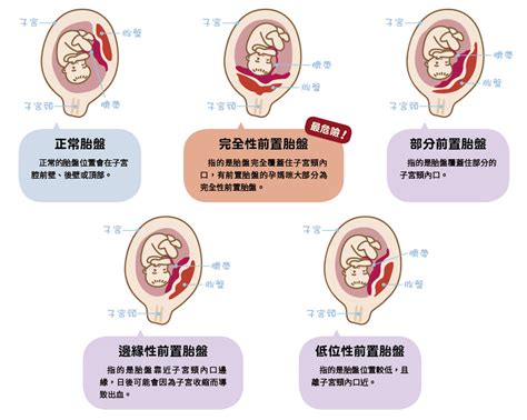 胎盤前置